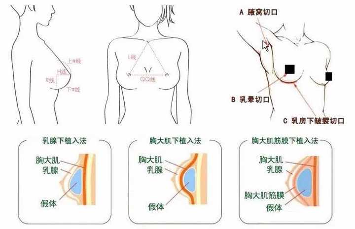 一个月内丰胸的有效方法与建议