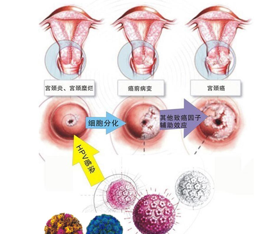 尖锐一个月能排除吗？——对尖锐湿疣的深入解析